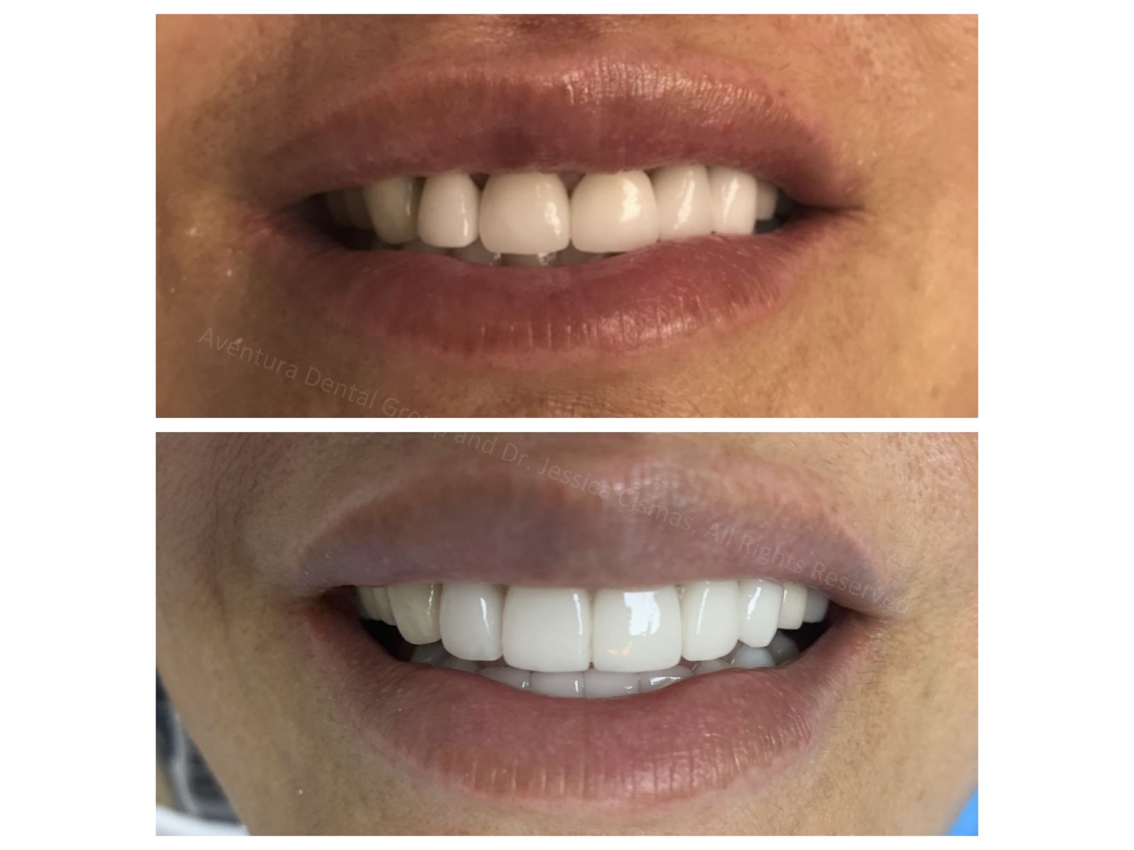 Dr. Jessica Cismas outdid herself again with another full mouth porcelain veneer case. She created a long lasting beautiful smile for this patient who absolutely loved the way her teeth look now. For a limited time Dr. Jessica Cismas will provide cosmetic consultations to the first 50 patients.