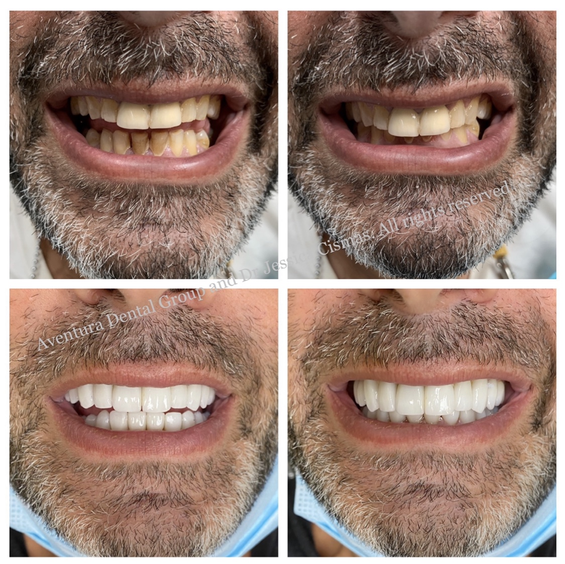 For the month of September, Aventura Dental Group and Dr. Jessica Cismas presents the latest aesthetic full mouth restoration done beautifully by our master ceramists. Dr. Jessica Cismas utilized the latest cutting edge technology and materials to obtain a gorgeous long lasting natural looking smile. The patient was blown away by the final result. He is part of the bigger Aventura Dental Group family, where almost all of our patients stay patients for life at our practice. Your smile can be changed too, by DM-ing us @aventuradentalgroup or by calling us at 305-935-4030. We are your local cosmetic dentist located in Aventura since 1985. Come check us out and experience the difference in quality for yourself.