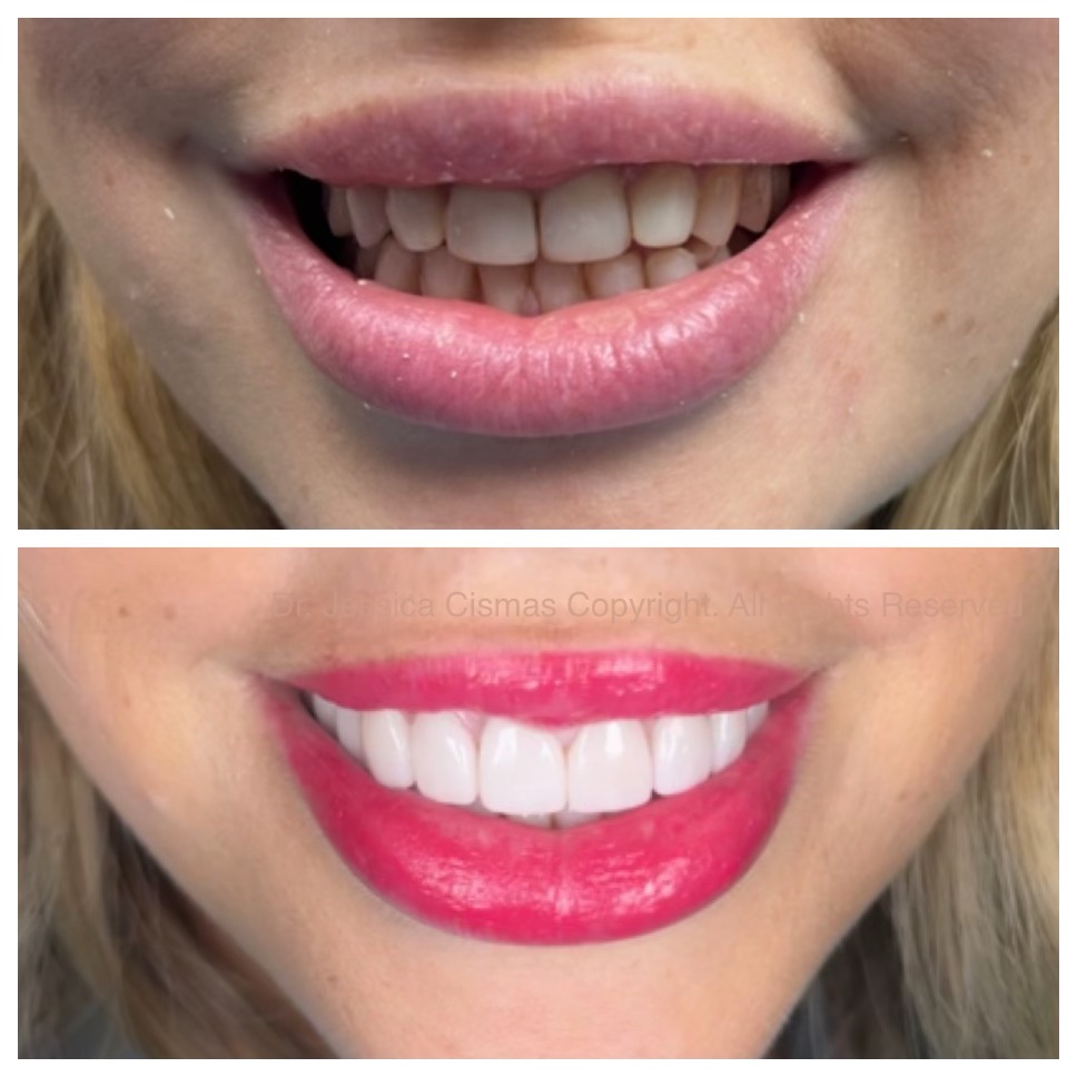 Local Aventura Dental Group dental practice does it again. This is a before and after image of a full mouth rehabilitation completed with porcelain veneers, dental crowns. The result is a beautiful form and function smile.
